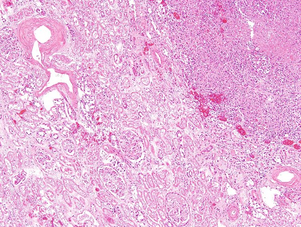 1D2 TB (Case 1) Kidney H&E 5A