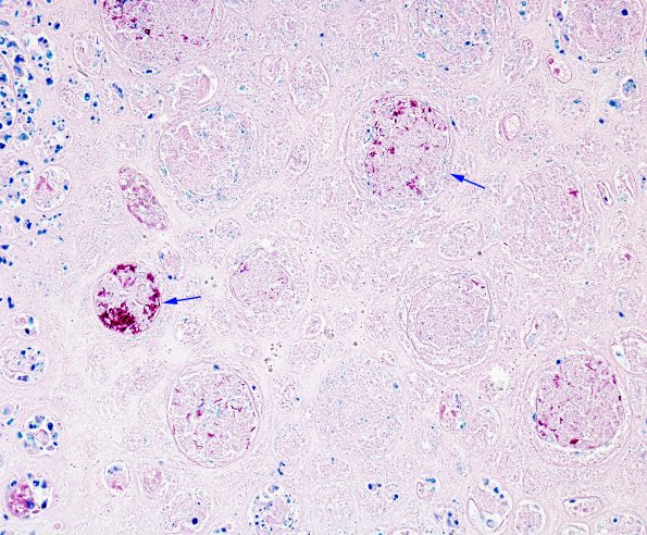 1E1 TB (Case 1) Kidney AFB 40X 2 copyA