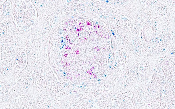 1E2 TB (Case 1) Kidney AFB 100X 2 copyA