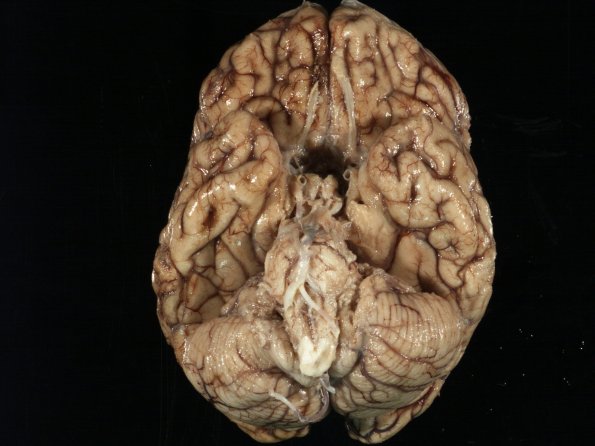 1F1 TB Meningitis, Ventriculitis, Tuberculoma, Rich foci (Case 1) Gross_8