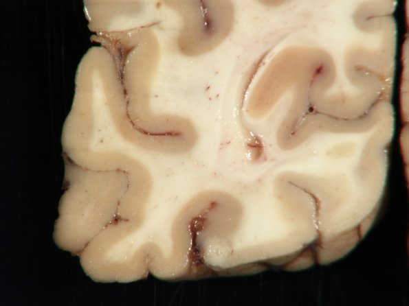 1F14 TB Meningitis, Ventriculitis, Tuberculoma, Rich foci (Case 1) Gross_41