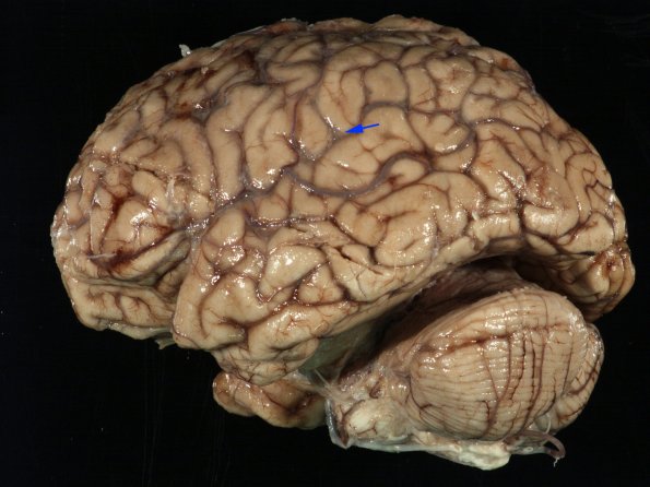 1F2 TB Meningitis, Ventriculitis, Tuberculoma, Rich foci (Case 1) Gross_10 copy