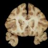 1F3 TB Meningitis, Ventriculitis, Tuberculoma, Rich foci (Case 1) Gross_24