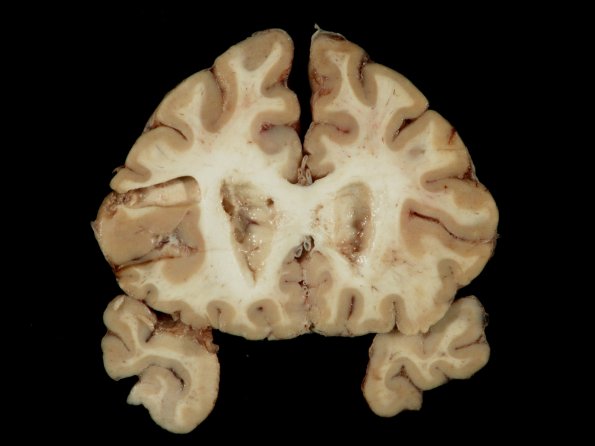 1F3 TB Meningitis, Ventriculitis, Tuberculoma, Rich foci (Case 1) Gross_24