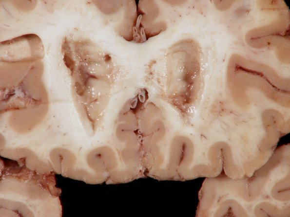 1F4 TB Meningitis, Ventriculitis, Tuberculoma, Rich foci (Case 1) 5