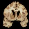 1F5 TB Meningitis, Ventriculitis, Tuberculoma, Rich foci (Case 1) Gross_26