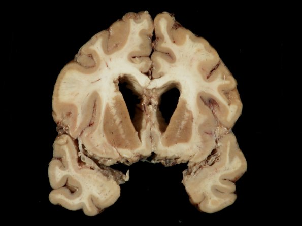 1F5 TB Meningitis, Ventriculitis, Tuberculoma, Rich foci (Case 1) Gross_26