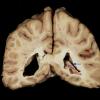 1F7 TB Meningitis, Ventriculitis, Tuberculoma, Rich foci (Case 1) Gross_37 copy