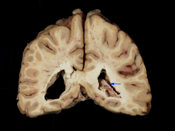 1F7 TB Meningitis, Ventriculitis, Tuberculoma, Rich foci (Case 1) Gross_37 copy