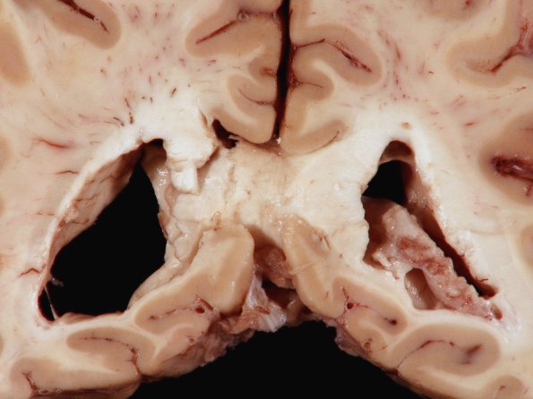 1F8 TB Meningitis, Ventriculitis, Tuberculoma, Rich foci (Case 1) 11