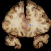 1F9 TB Meningitis, Ventriculitis, Tuberculoma, Rich foci (Case 1) Gross_33 copy