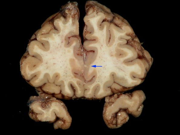 1F9 TB Meningitis, Ventriculitis, Tuberculoma, Rich foci (Case 1) Gross_33 copy