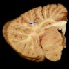 1G2 TB Meningitis, Ventriculitis, Tuberculoma, Rich foci (Case 1) Gross_17 copy