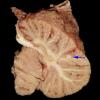 1G2 TB Meningitis, Ventriculitis, Tuberculoma, Rich foci (Case 1) Gross_20 copy