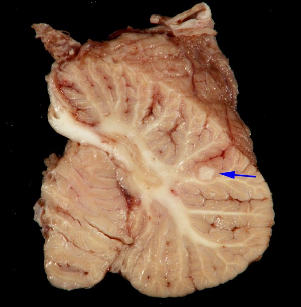 1G2 TB Meningitis, Ventriculitis, Tuberculoma, Rich foci (Case 1) Gross_20 copy