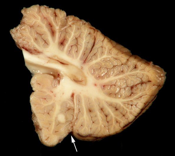 1G3 TB Meningitis, Ventriculitis, Tuberculoma, Rich foci (Case 1) Gross_18 copy