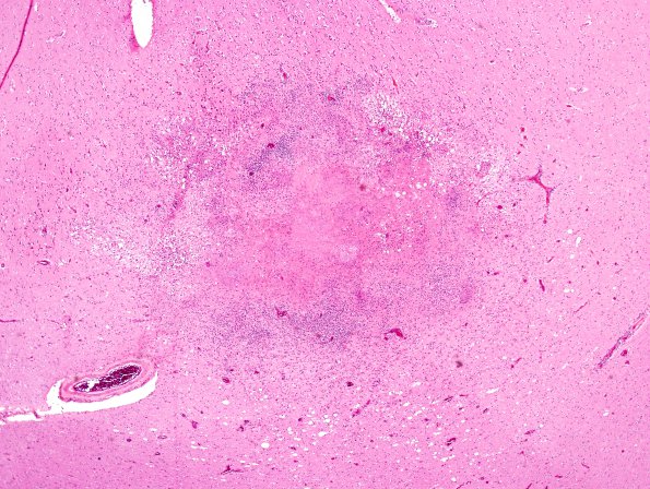 1H6 TB, tuberculoma (Case 1) H&E 1