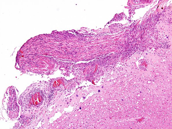 1J TB (Case 1) H&E 4