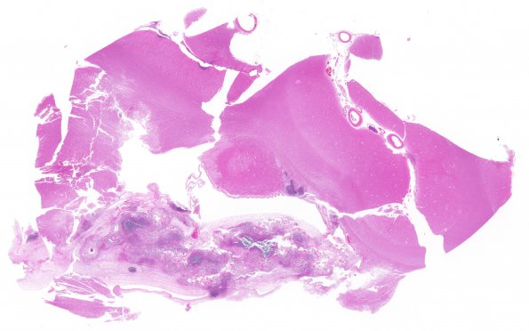 1K1 TB (Case 1) N12 (choroid plexitis) H&E whole mount