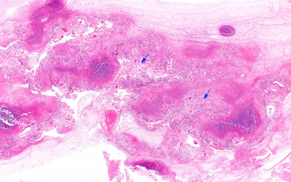 1K2 TB (Case 1) N12 Choroid Plexus 2X copy