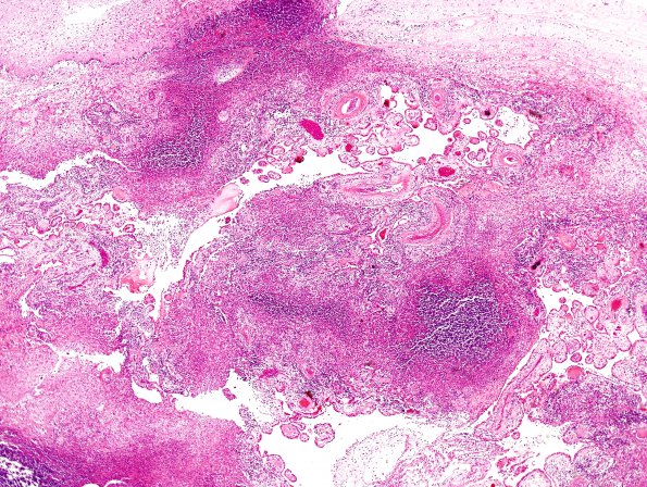 1K3 TB (Case 1) N12 (choroid plexitis) H&E 2A