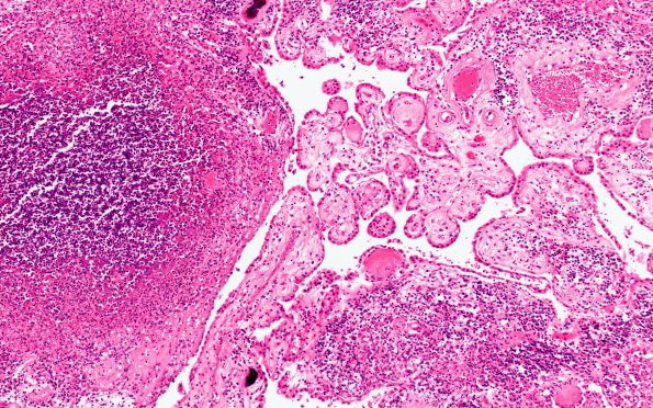 1K4 TB (Case 1) N12 Choroid plexus H&E 20X