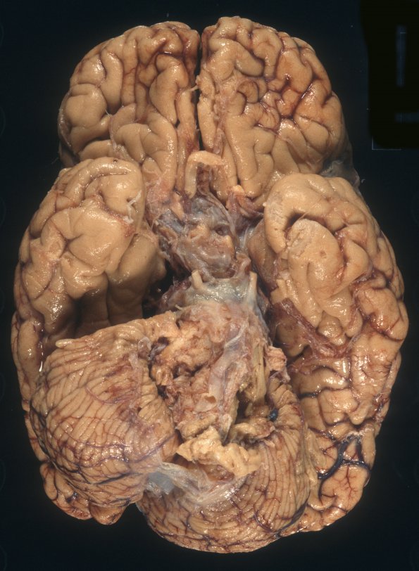 10A1 TB meningitis, partially treated (Case 10) Gross 1