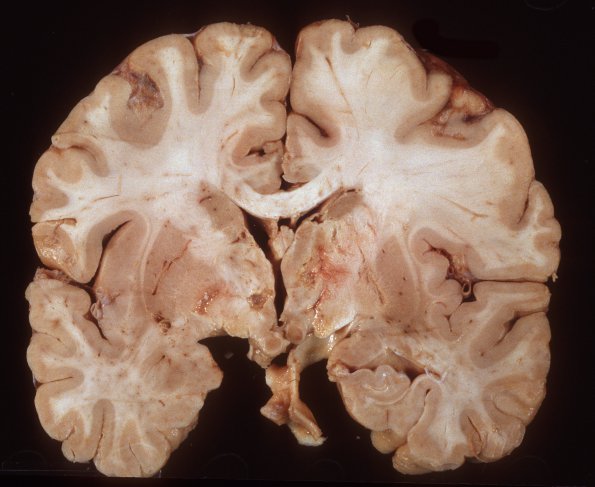 10A3 TB meningitis, treated, infarcts (Case 10) gross 1