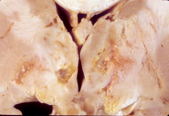 10A4 TB Meningitis (Case 10) 4