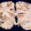 12A TB Tuberculoma (Case 12) copy