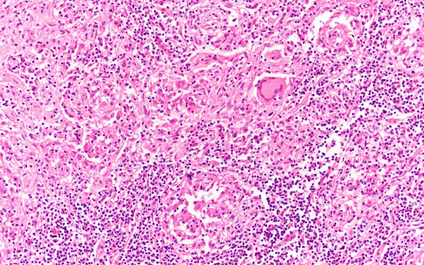 12B TB Tuberculoma (Case 12) 20X