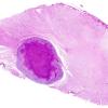 13 TB Tuberculoma (Case 13) H&E whole mount