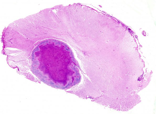 13 TB Tuberculoma (Case 13) H&E whole mount