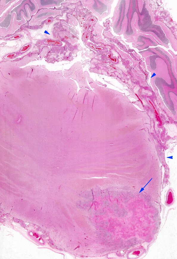 14A1 TB Tuberculoma (Case 14) H&E whole mount copy