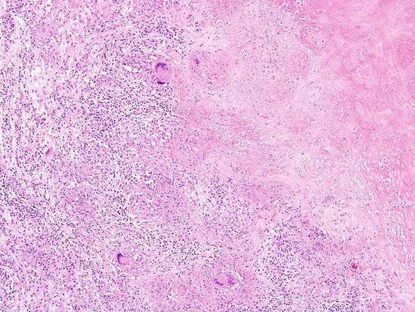 14A2 TB Tuberculoma (Case 14) H&E 3