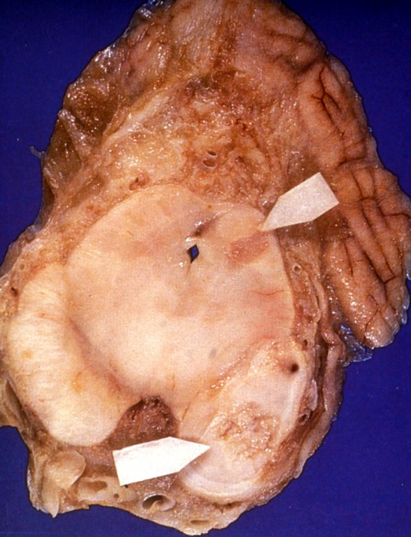 16 TB Meningitis, Arteritis (Case 16) 1 infarcts