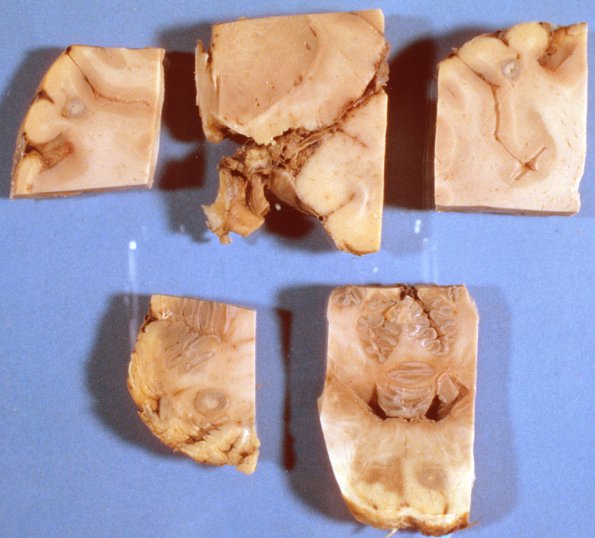 17 TB Tuberculoma & Meningitis (Case 17) 1