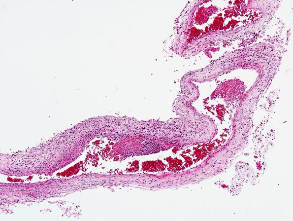 2A1 TB Meningitis & Vasculitis (Case 2) H&E 5