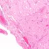 2A2 TB Meningitis & Vasculitis (Case 2) H&E A1