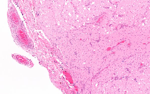 2A2 TB Meningitis & Vasculitis (Case 2) H&E A1