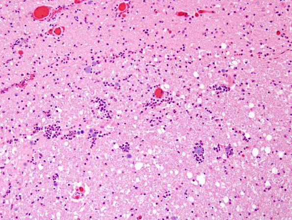 2A3 TB Meningitis & Vasculitis (Case 2) H&E 7