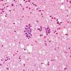 2A4 TB Meningitis & Vasculitis (Case 2) H&E 8