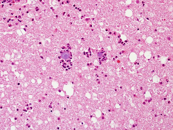 2A4 TB Meningitis & Vasculitis (Case 2) H&E 8