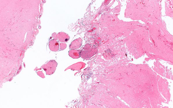 2A6 TB Meningitis & Vasculitis (Case 2) N10 H&E 2X