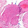 2A7 TB Meningitis & Vasculitis (Case 2) N10 H&E 1 copy