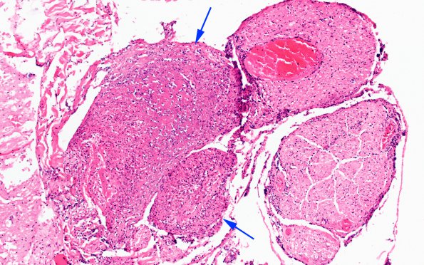 2A7 TB Meningitis & Vasculitis (Case 2) N10 H&E 1 copy