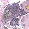 2B TB Meningitis & Vasculitis (Case 2) N10 VVG 1 copy