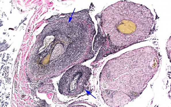 2B TB Meningitis & Vasculitis (Case 2) N10 VVG 1 copy