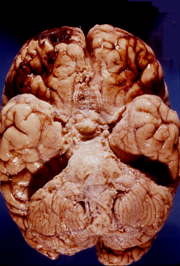 3A1 TB Meningitis (Case 3) gross 1