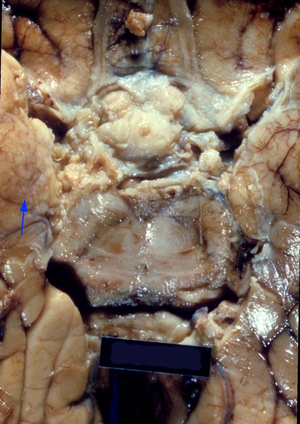 3A3 TB Meningitis (Case 3) A7 copy